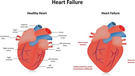 hypokinetic heart